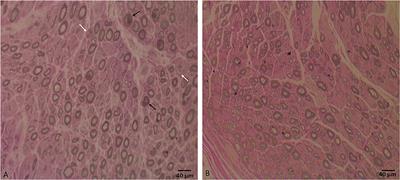 Case report: A novel homozygous histidine triad nucleotide-binding protein 1 mutation featuring distal hereditary motor-predominant neuropathy with rimmed vacuoles